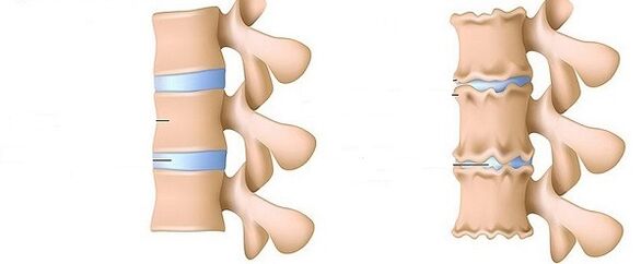 unha columna vertebral saudable e osteocondrose