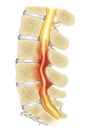 Coa osteocondrose da columna vertebral torácica, hai compresión da canle espiñal