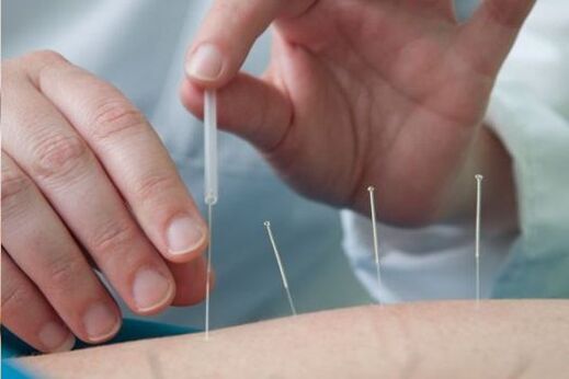 Acupuntura - un método para tratar a dor na rexión lumbar causada pola osteocondrose