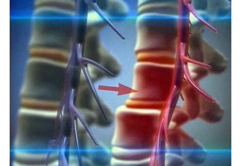 Trituración de terminacións nerviosas na osteocondrose lumbar