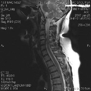 Osteocondrose e espondilose da columna cervical