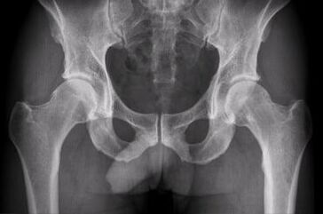 Opcións de diagnóstico para a artrose da articulación da cadeira