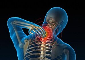 Por que se desenvolve e como se manifesta a osteocondrosis cervical