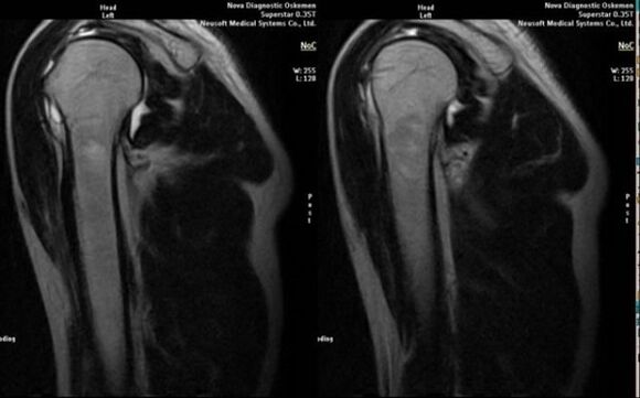 Radiografía para diagnosticar a artrose do ombreiro