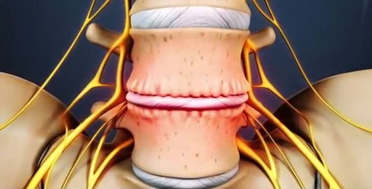 Lesións da columna vertebral por osteocondrose